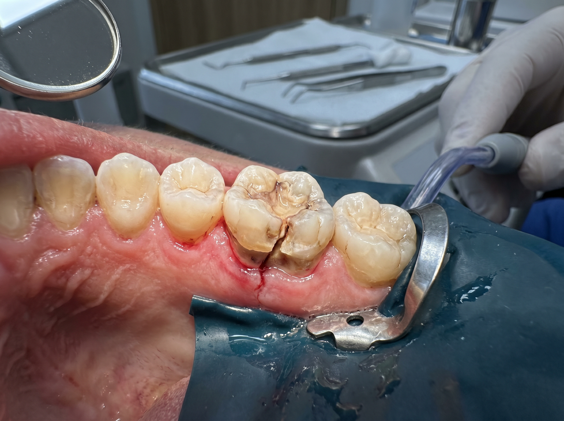 Close-up of a dental procedure on molars, with a drill working on a decayed tooth in a patient’s mouth.