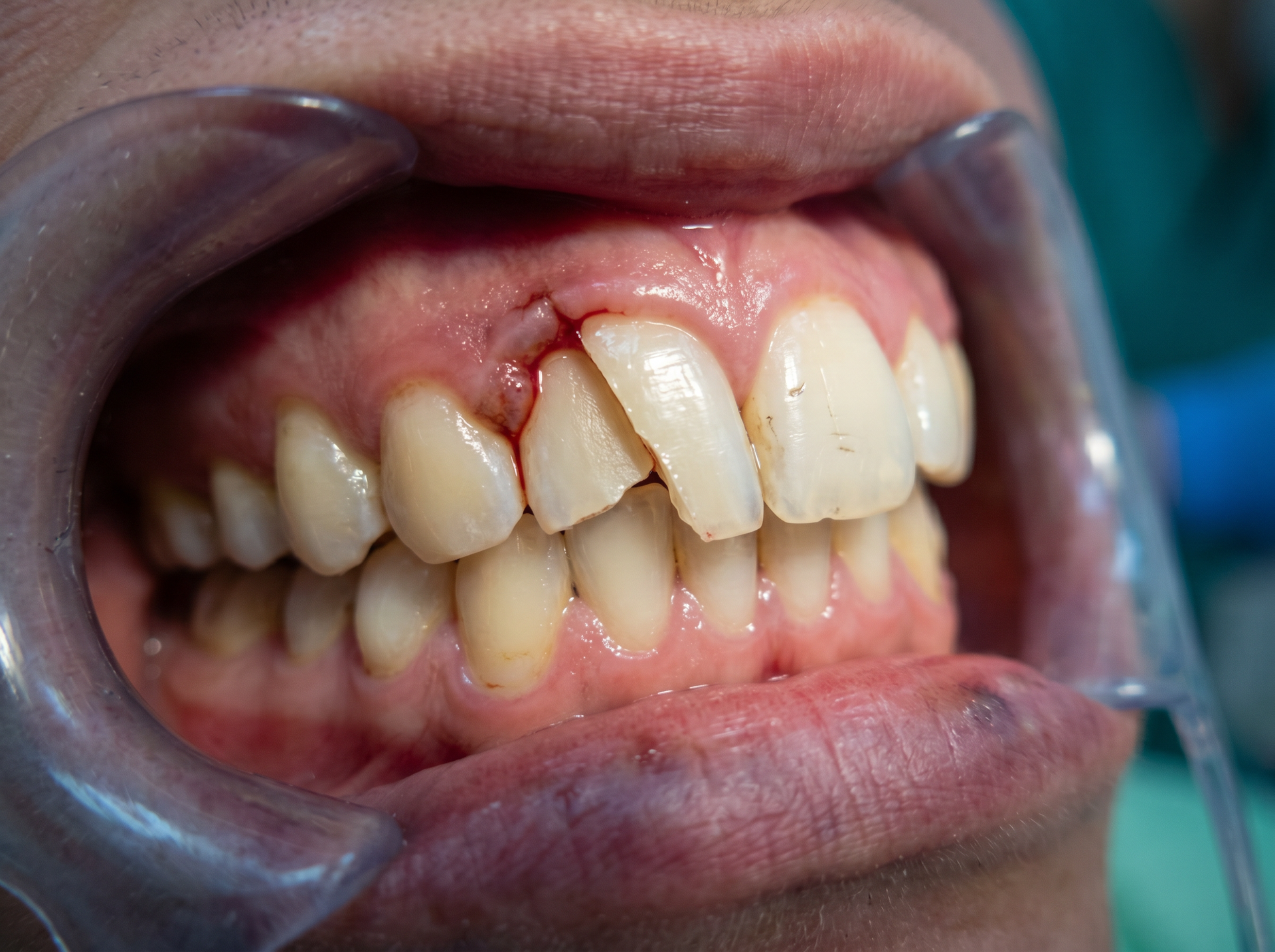 Close-up of crooked upper teeth and gums with a dental cheek retractor in place