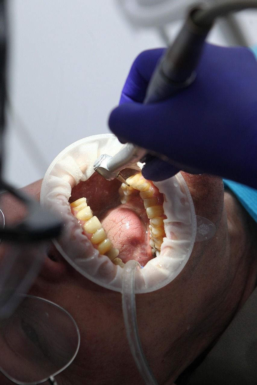 Dental filling procedure in Meridian, ID