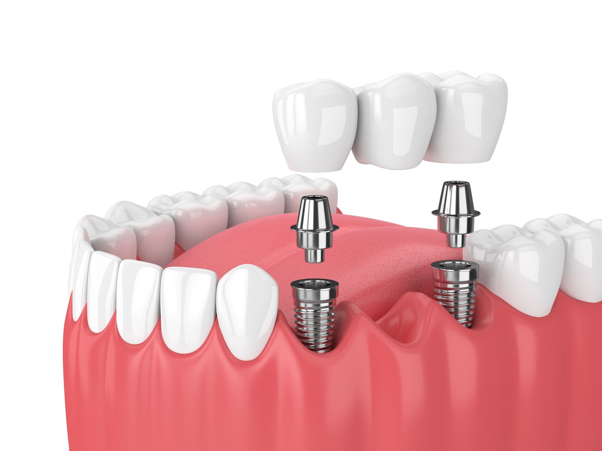 Implant Supported Dentures