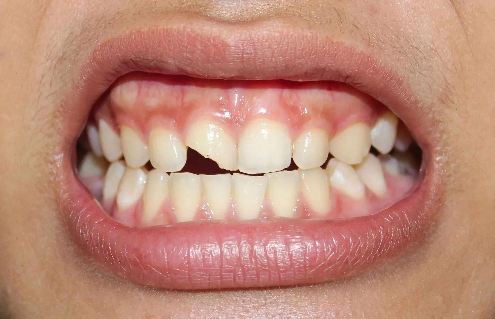 Close-up of a mouth with crooked front teeth and slightly reddened gums
