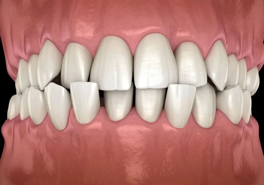Close-up of a mouth showing misaligned white teeth and pink gums