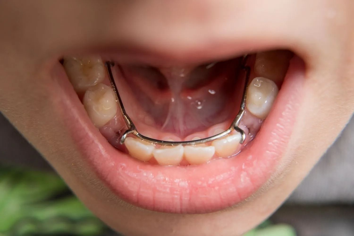 Close-up of a child’s mouth with lower front teeth secured by a metal dental retainer