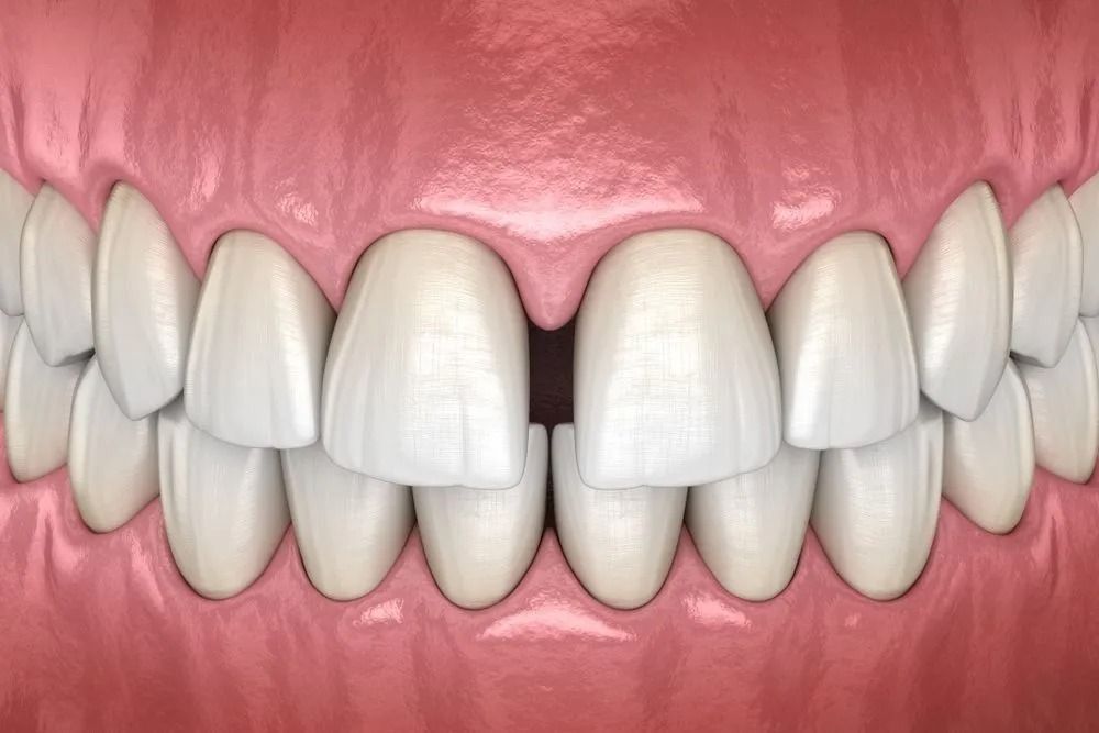 Close-up of white upper and lower teeth with pink gums and aligned front teeth