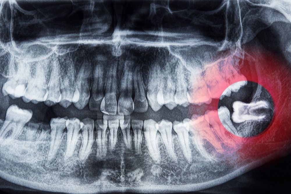 Dental X-ray of teeth and jaw with a highlighted impacted wisdom tooth in red circle