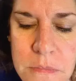 Close-up of a person with eyes closed and a neutral expression, showing a bruise on the cheek.