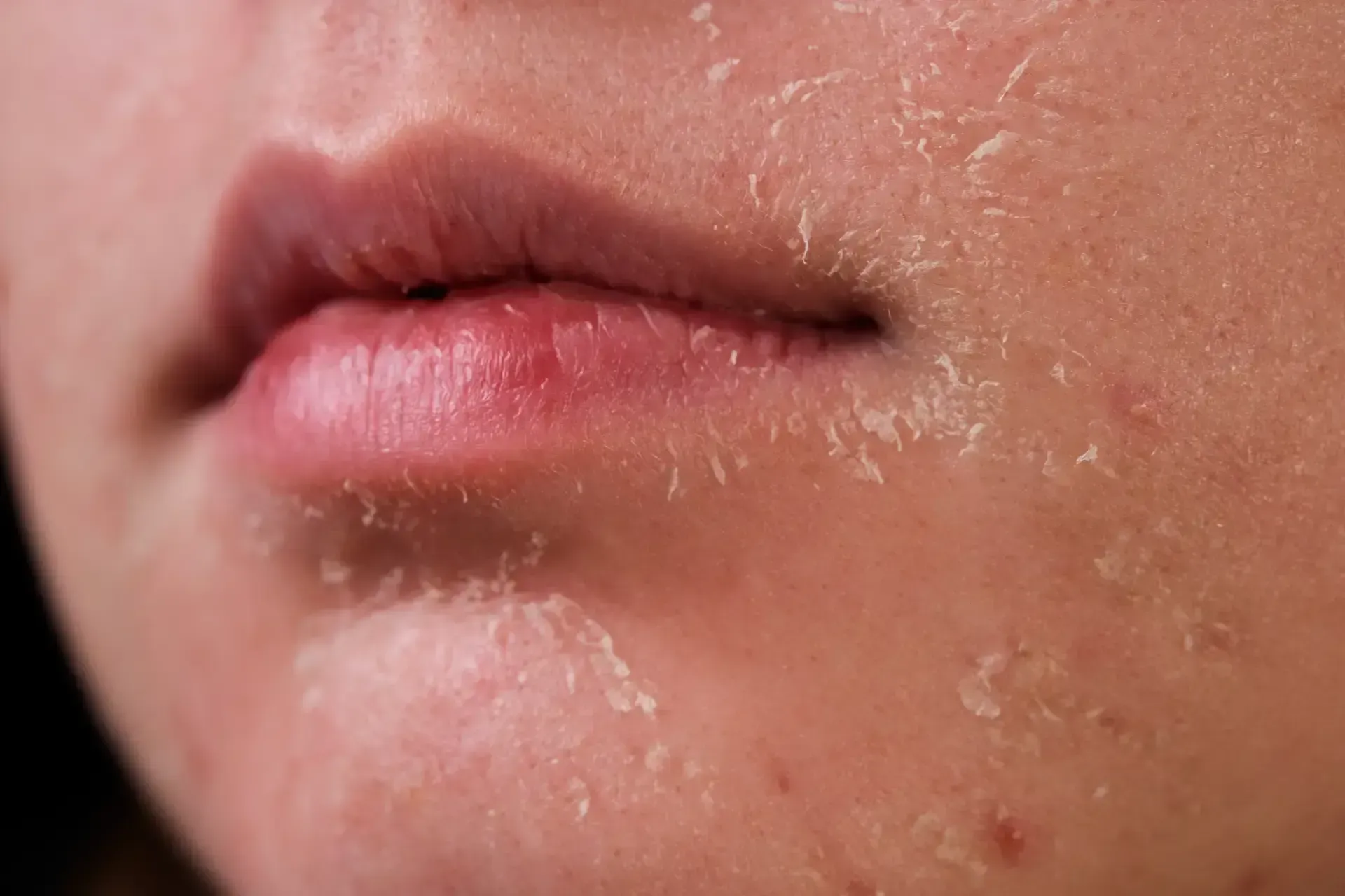 Close-up of chapped lips and dry, flaky skin on a person’s chin and lower face