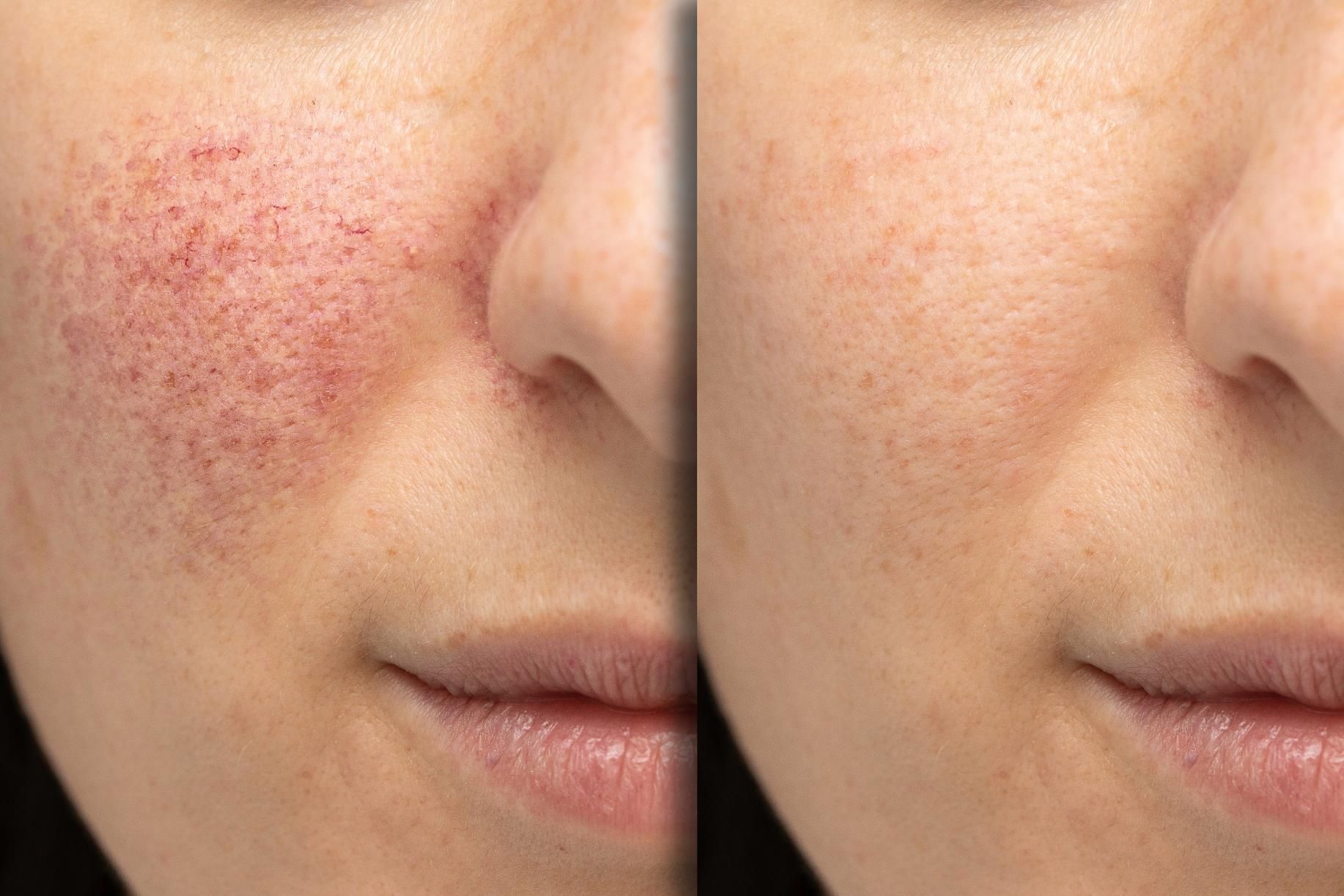Side-by-side close-up of a cheek before and after acne redness treatment