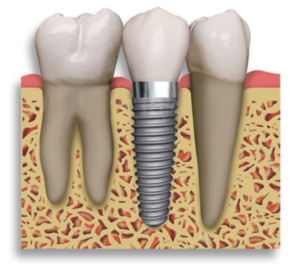 denti naturali e impianto dentale