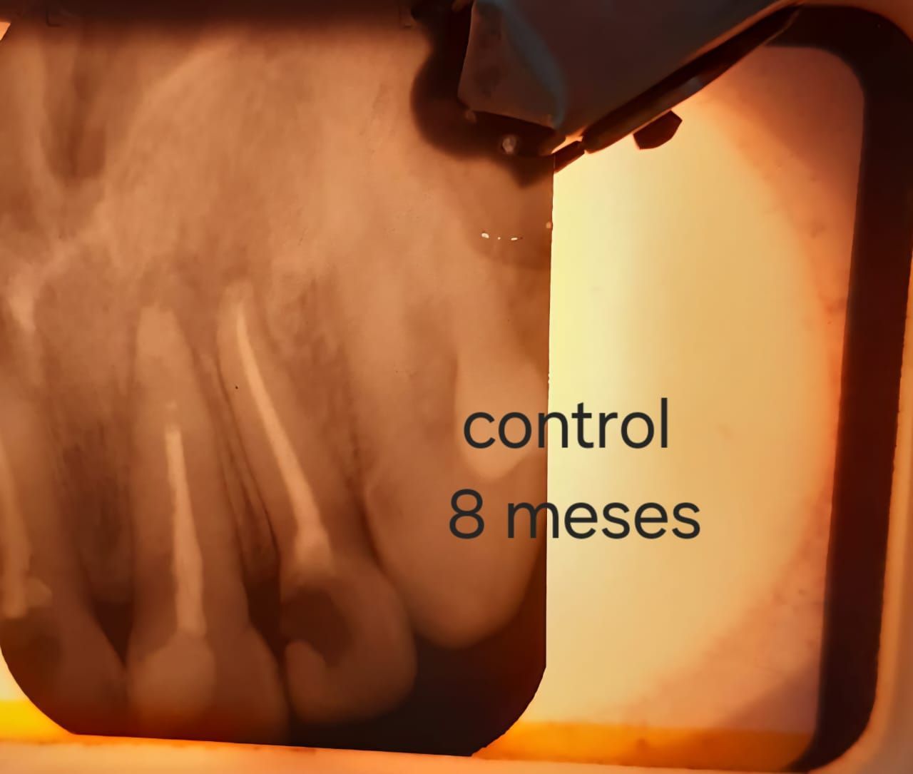 Radiografía dental de diente con tratamiento de conducto; etiqueta 