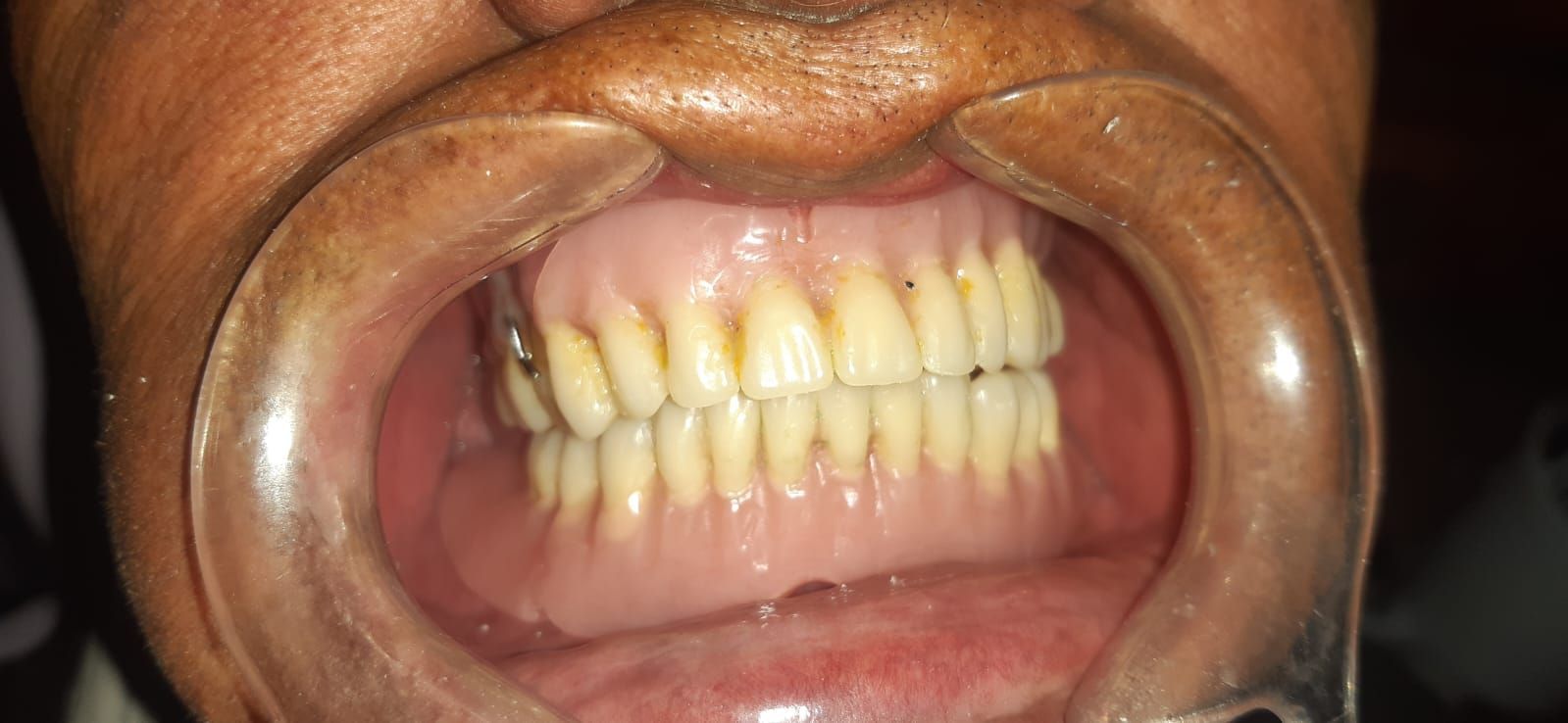 Boca bien abierta con dentadura postiza sujeta en su lugar por un retractor dental.
