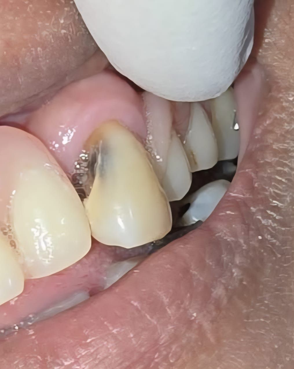 Primer plano de los dientes, foco en un diente frontal dañado con un área oscura, un dedo enguantado tocándolo.