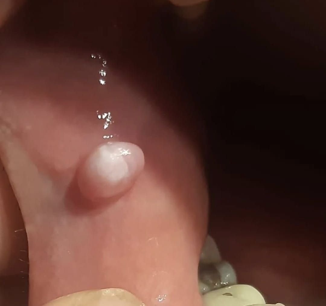 Una vista de cerca muestra un crecimiento grande, elevado y blanquecino en la mejilla interna, cerca de los dientes.
