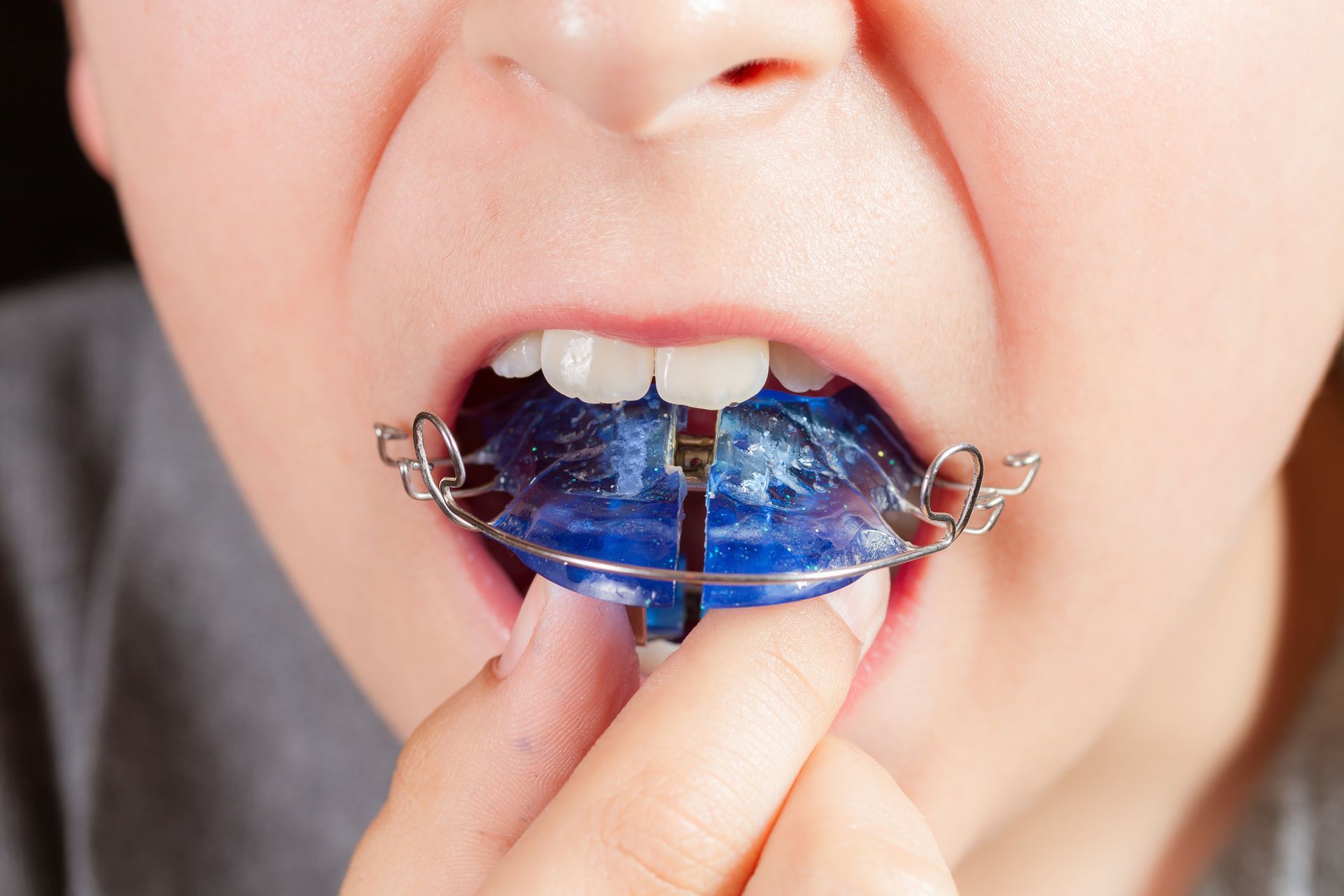 Close-up of a mouth with braces holding a blue orthodontic mouthguard