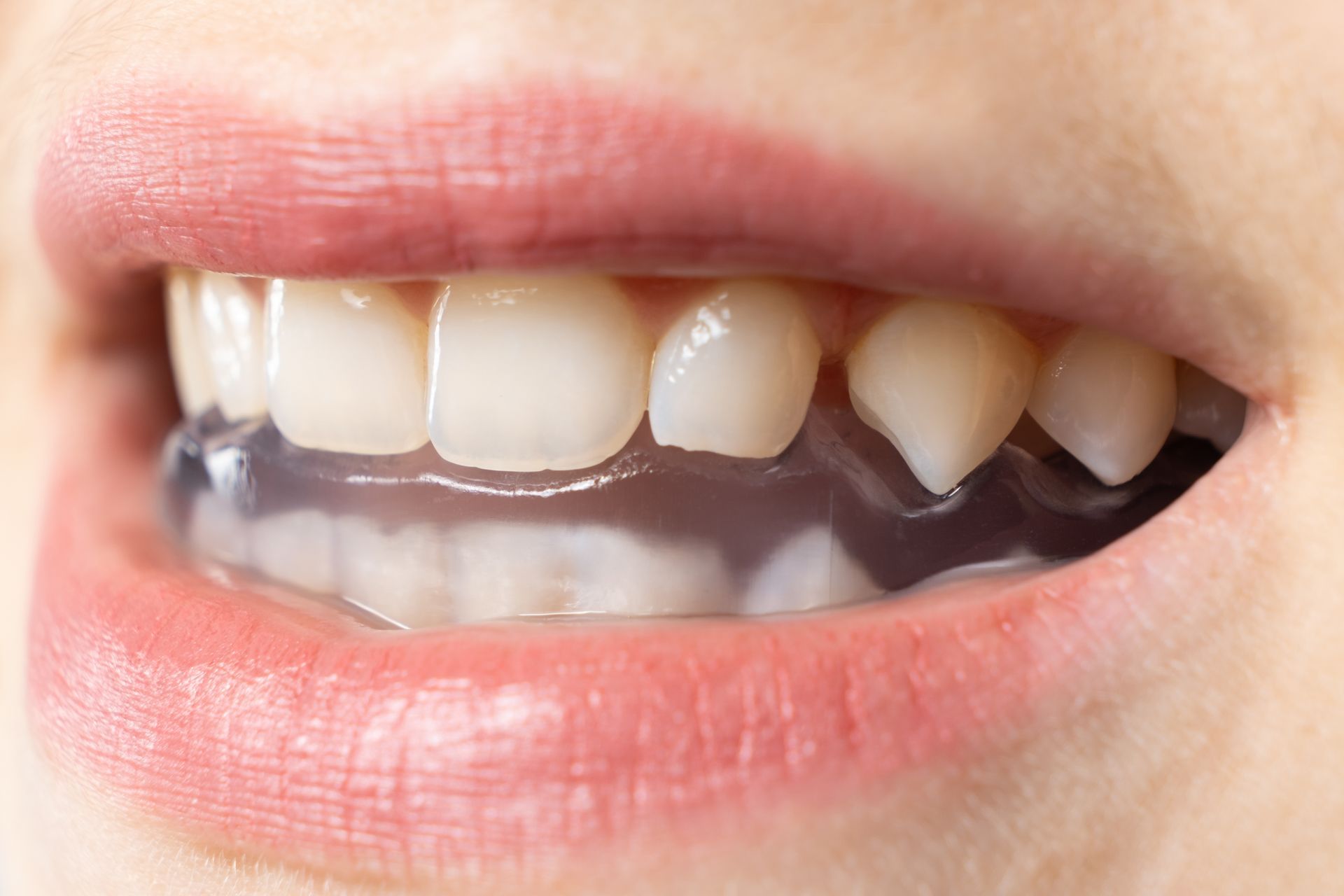 Close-up of a smiling mouth showing a row of crooked white teeth