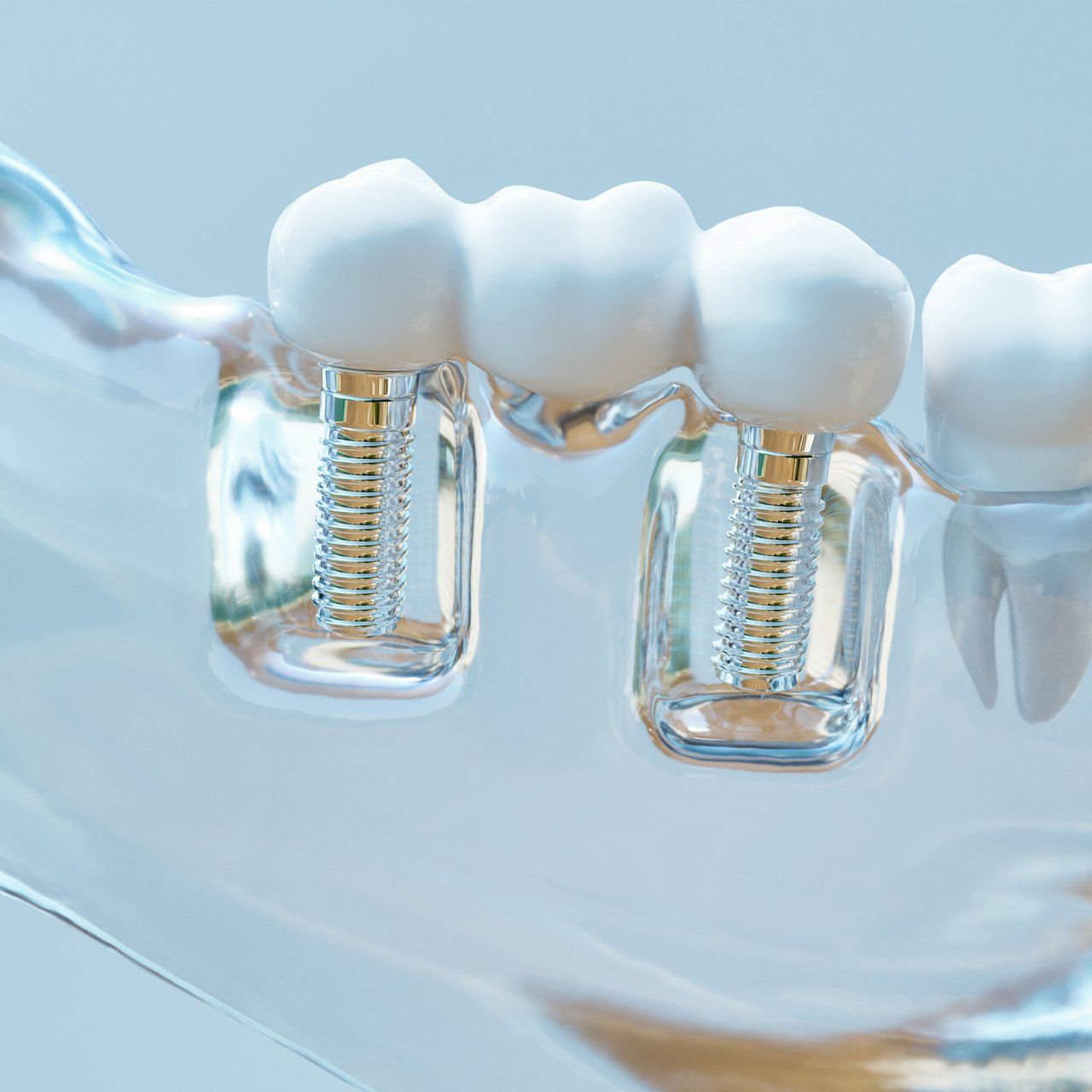 Intra-Lock Dental Implant — Frankfort, IL — Brookside Dental Care Intra-Lock Dental Implant — Frankfort, IL — Brookside Dental Care