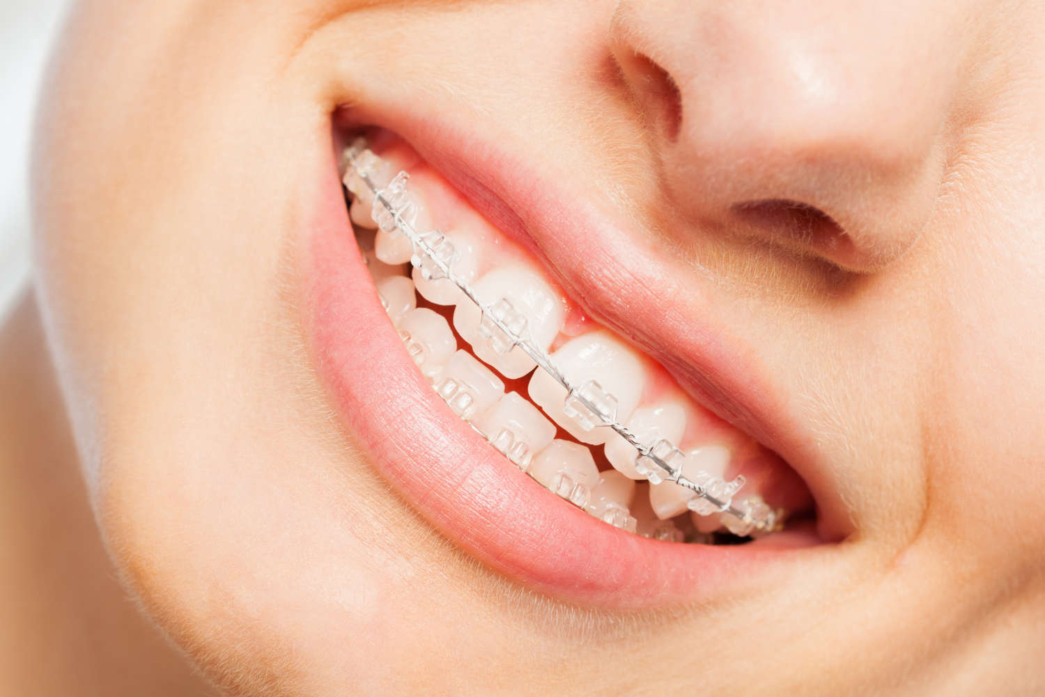 Close-up of a person's mouth with clear braces. Smiling, showing teeth and gums, soft pink lips.