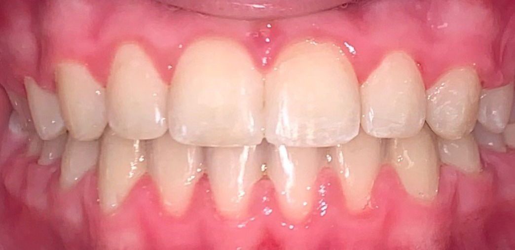 A close up of a man 's teeth with a beard.