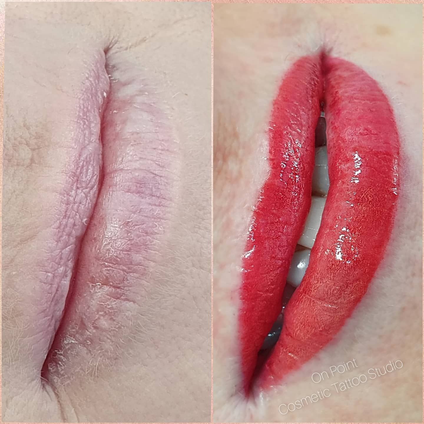 Before-and-after of a Lip Scar. Red Lip Tattoo Covers the Scar, Creating a Defined Shape With Red Gloss — On Point Cosmetic Tattoo Studio In Buderim, QLD