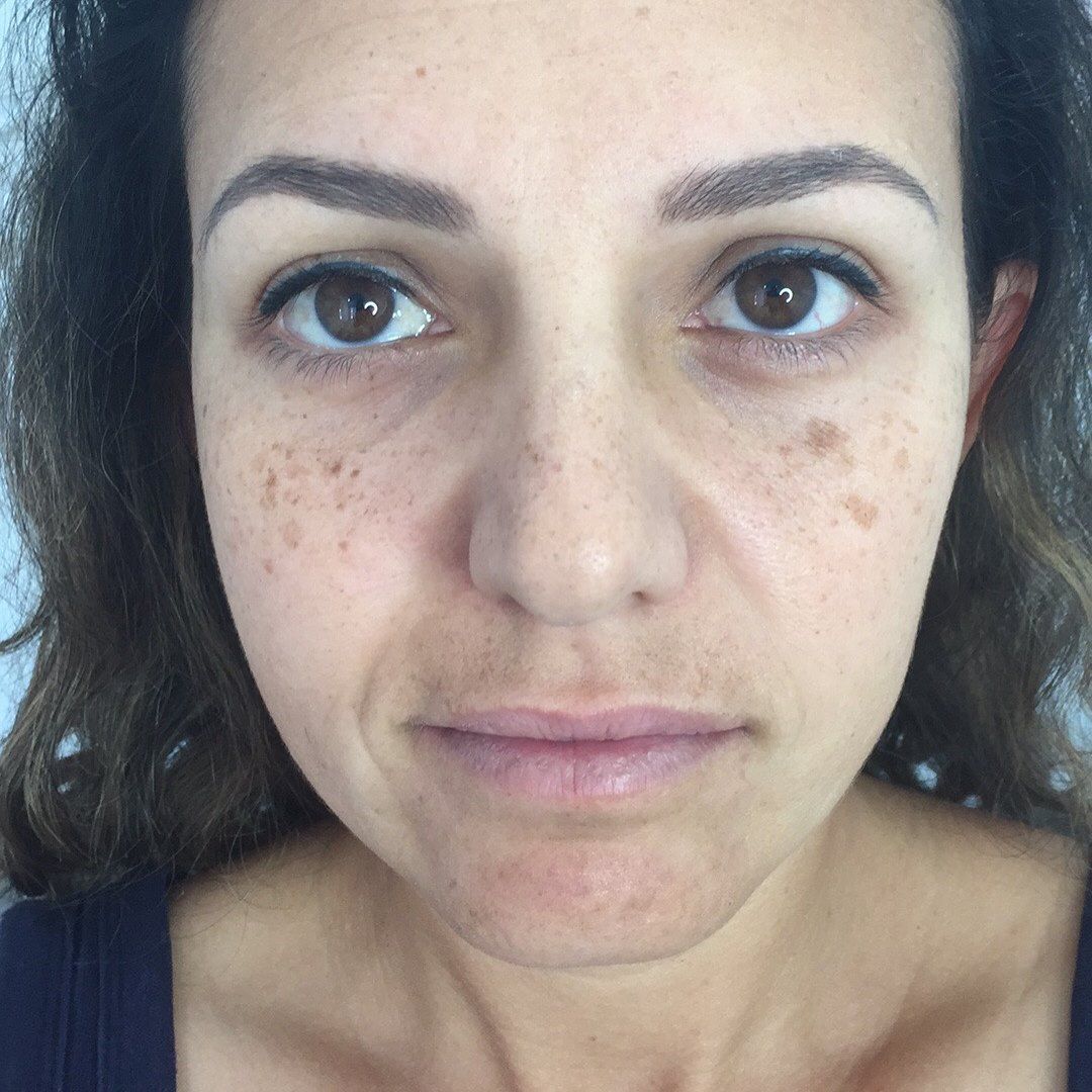 Woman's Face With Light Brown Skin, Dark Eyes, and Freckles — On Point Cosmetic Tattoo Studio In Buderim, QLD