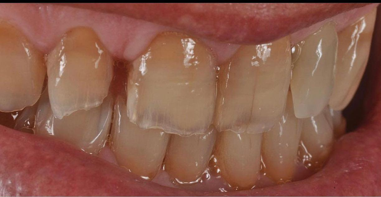 Il prima del trattamento faccette dentali a Roma
