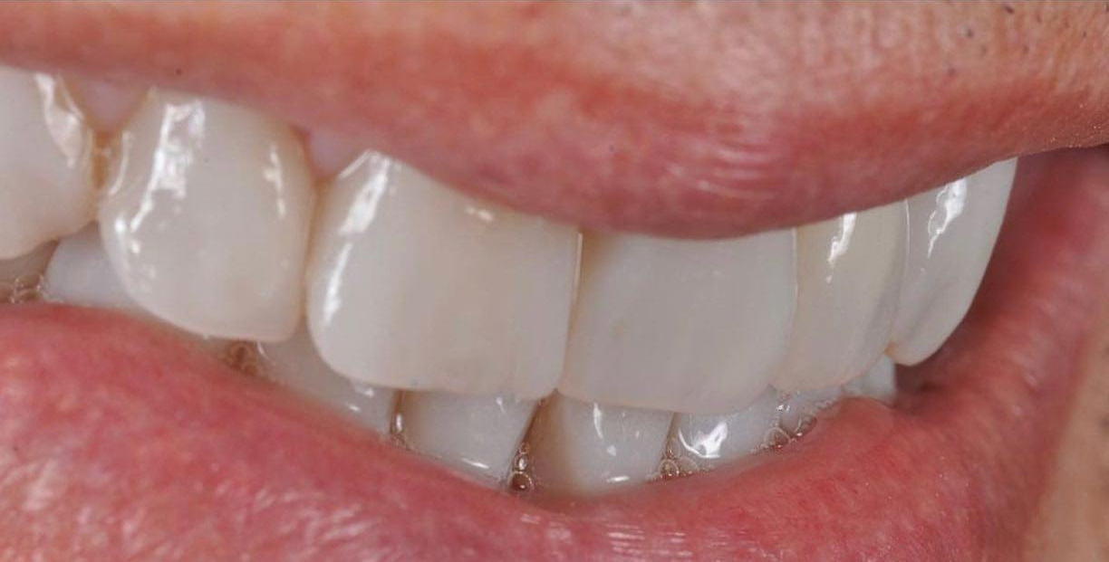 Il dopo del trattamento faccette dentali a Roma