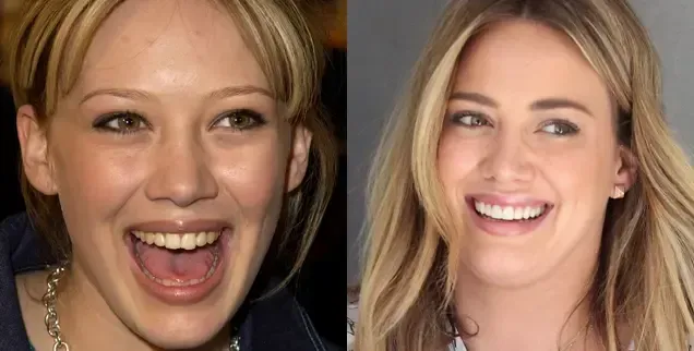 Risultati del trattamento faccette dentali a Roma