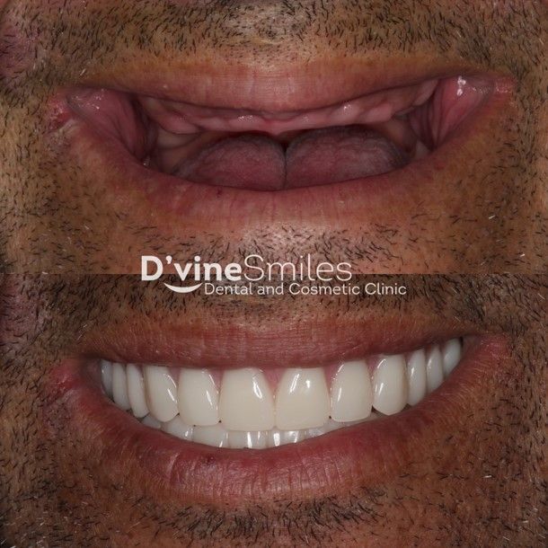 Implants & Dentures Results Melbourne, VIC D'vine Smiles