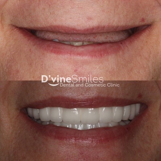Implants & Dentures Results Melbourne, VIC D'vine Smiles