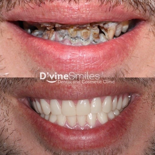 Implants & Dentures Results Melbourne, VIC D'vine Smiles