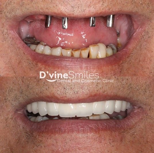 Implants & Dentures Results Melbourne, VIC D'vine Smiles