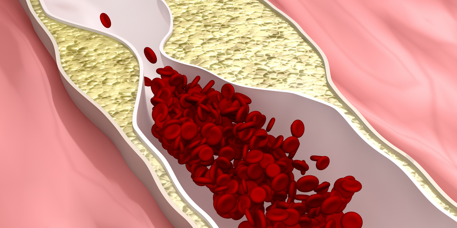 This is an image of blood cells struggling to pass through fatty deposits in a vein.