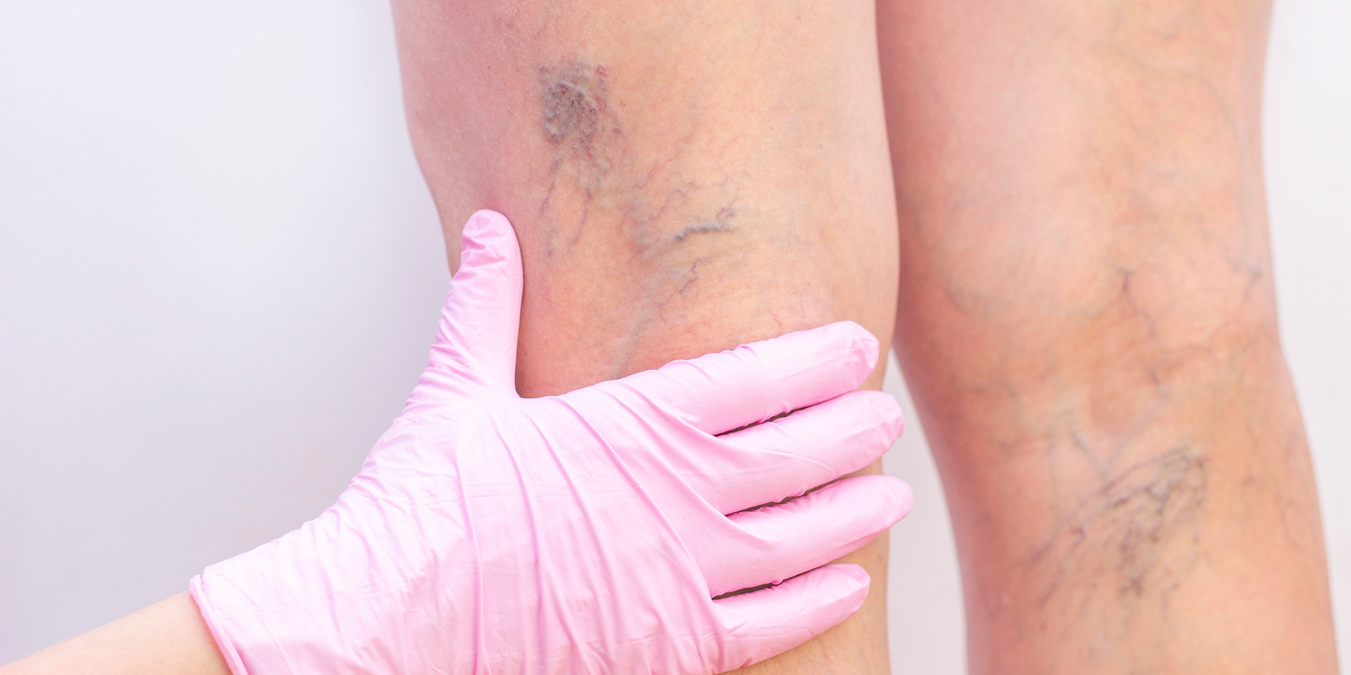 A person wearing pink gloves is examining a woman 's leg with varicose veins.