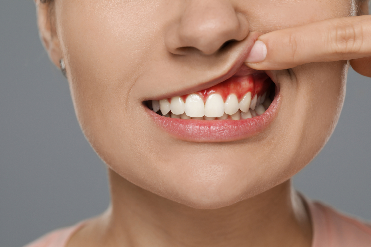 Person with visible bleeding gums, finger lifting lip.
