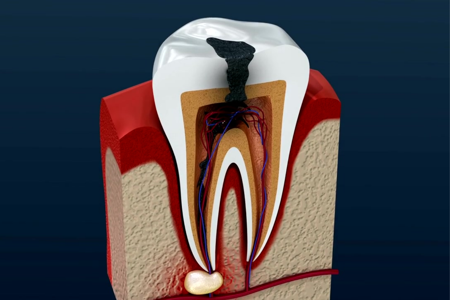 Cross-section of a tooth showing a cavity with decay, root canals, and inflamed tissue.