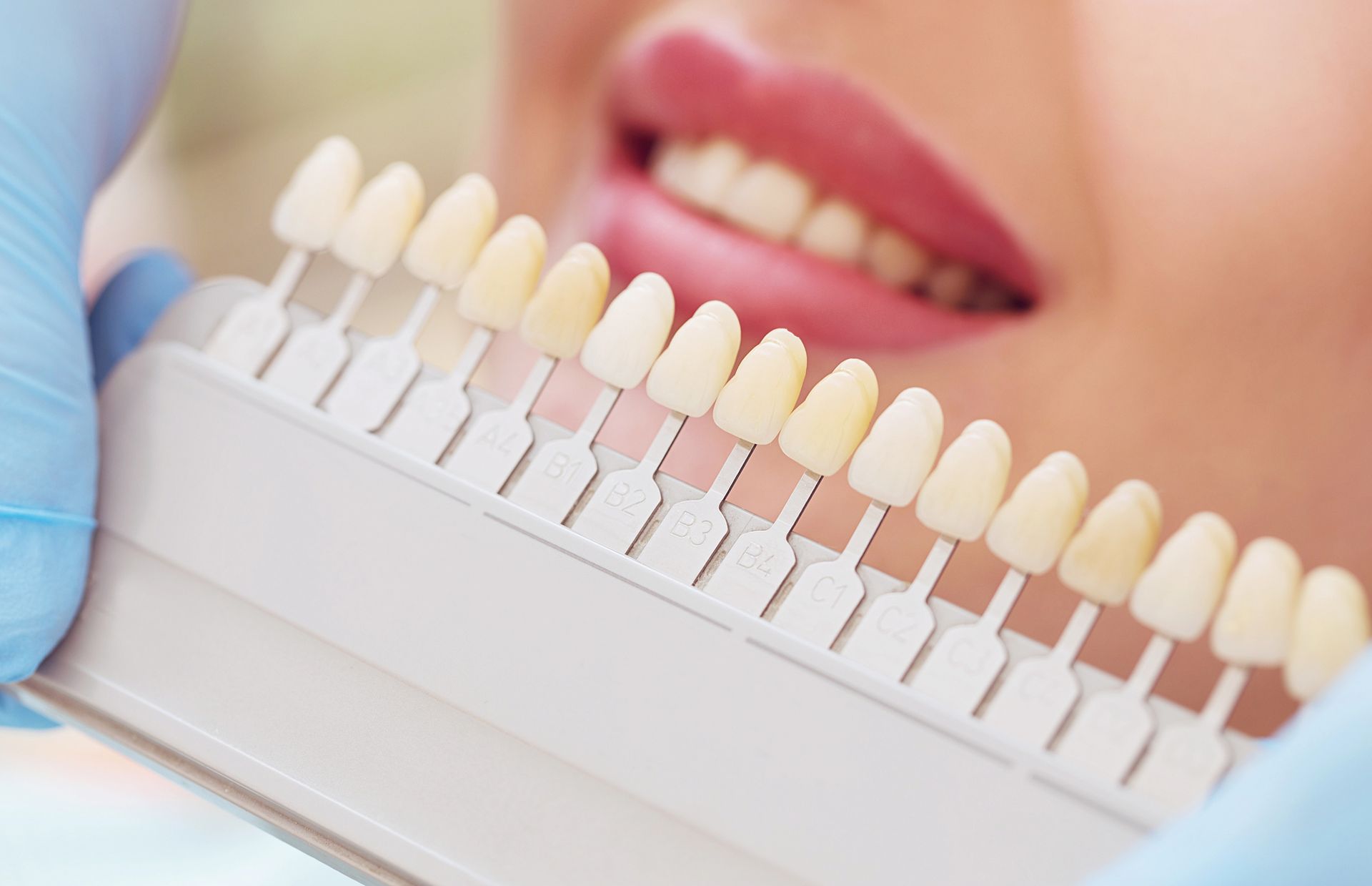 Un dentista con i guanti blu tiene una scala cromatica dentale accanto ai denti di un paziente per trovare la tonalità giusta.
