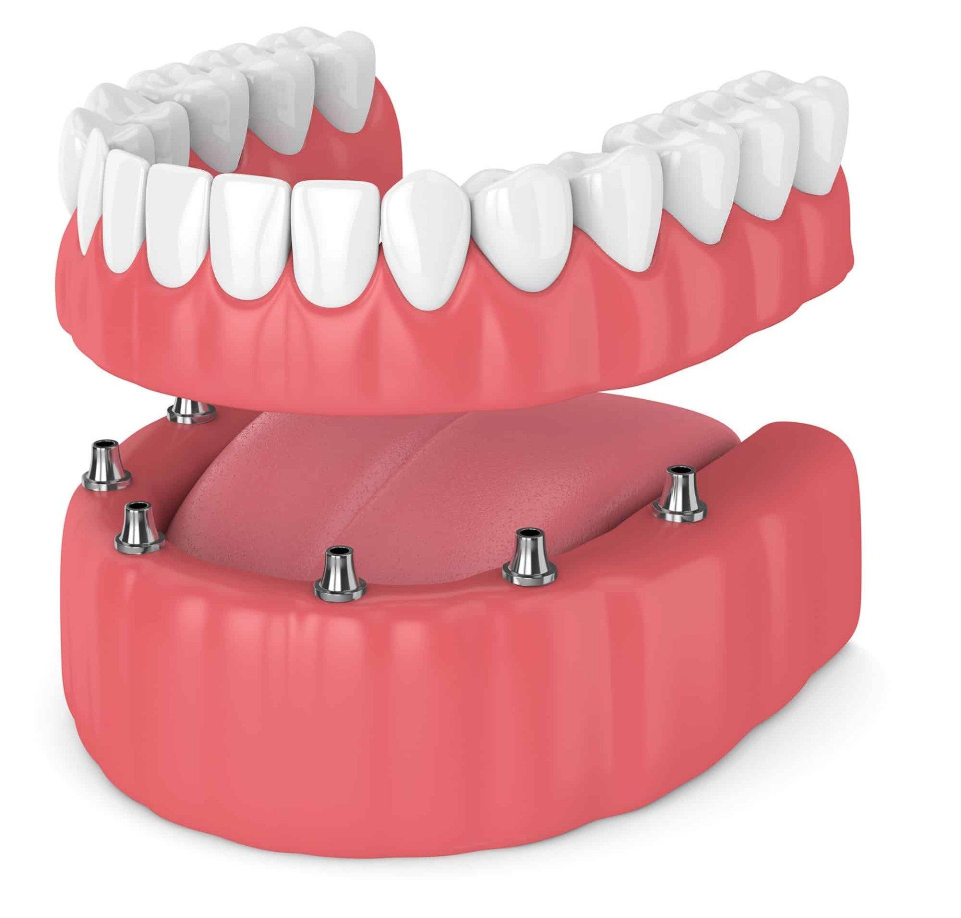 A 3d rendering of a full denture with dental implants.