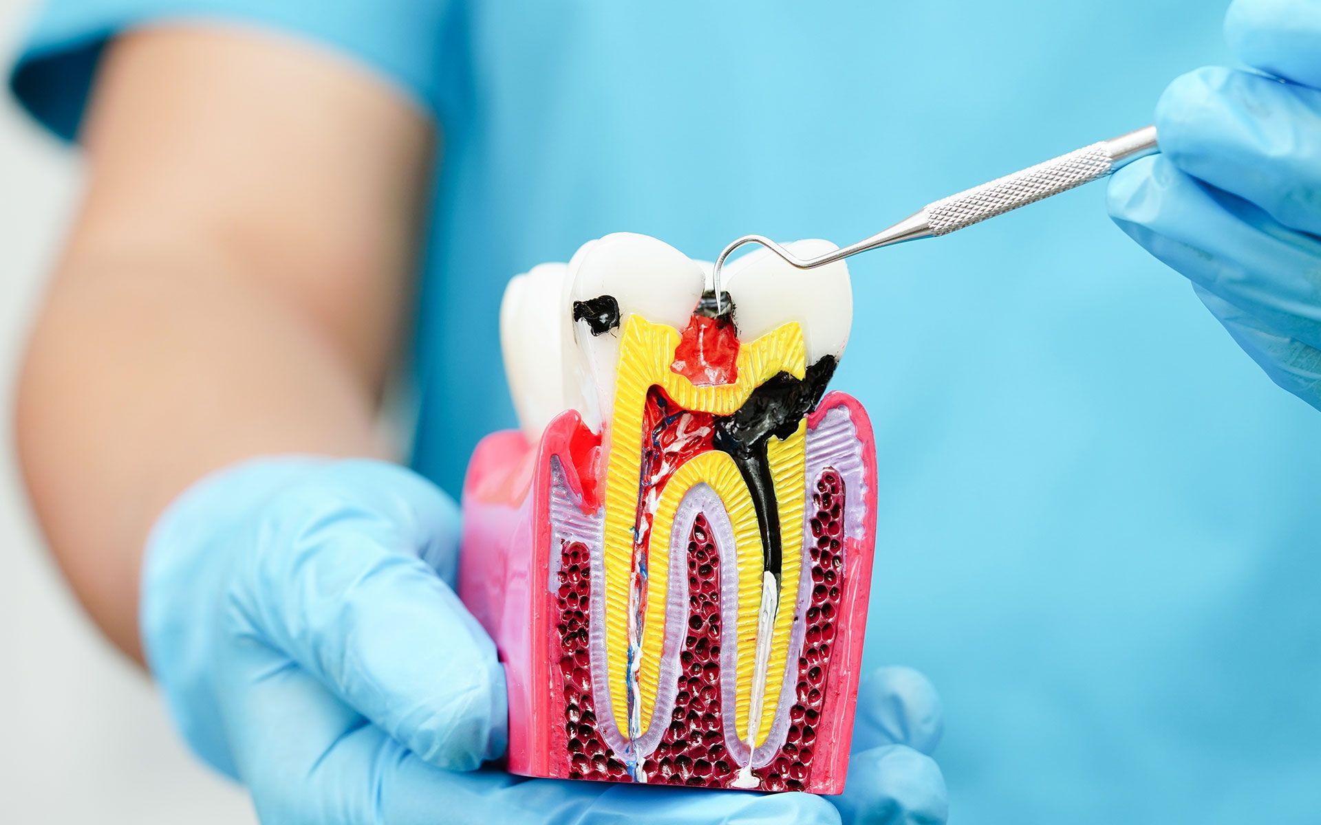 A dentist is holding a model of a tooth with a toothpick in it.