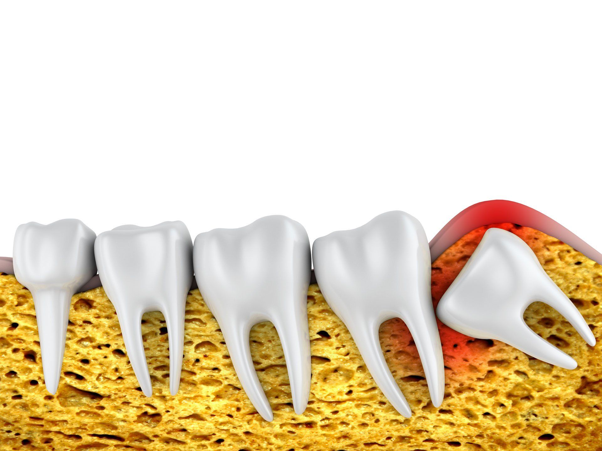 Wisdom tooth how it aches – Blacktown, NSW – Smiles for All Wisdom tooth how it aches – Blacktown, NSW – Smiles for All