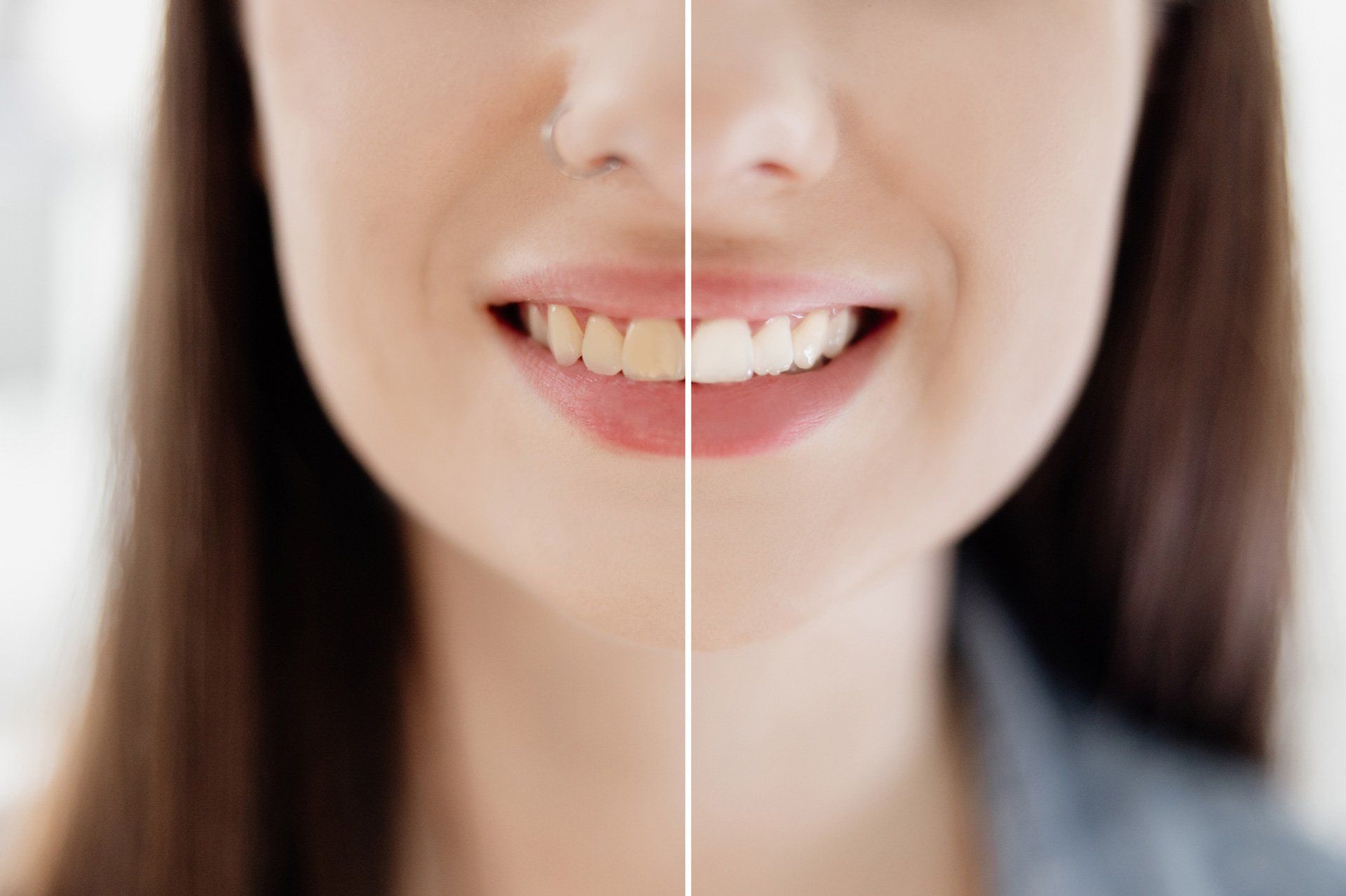 A difference between white and yellow teeth – Blacktown, NSW – Smiles for All A difference between white and yellow teeth – Blacktown, NSW – Smiles for All