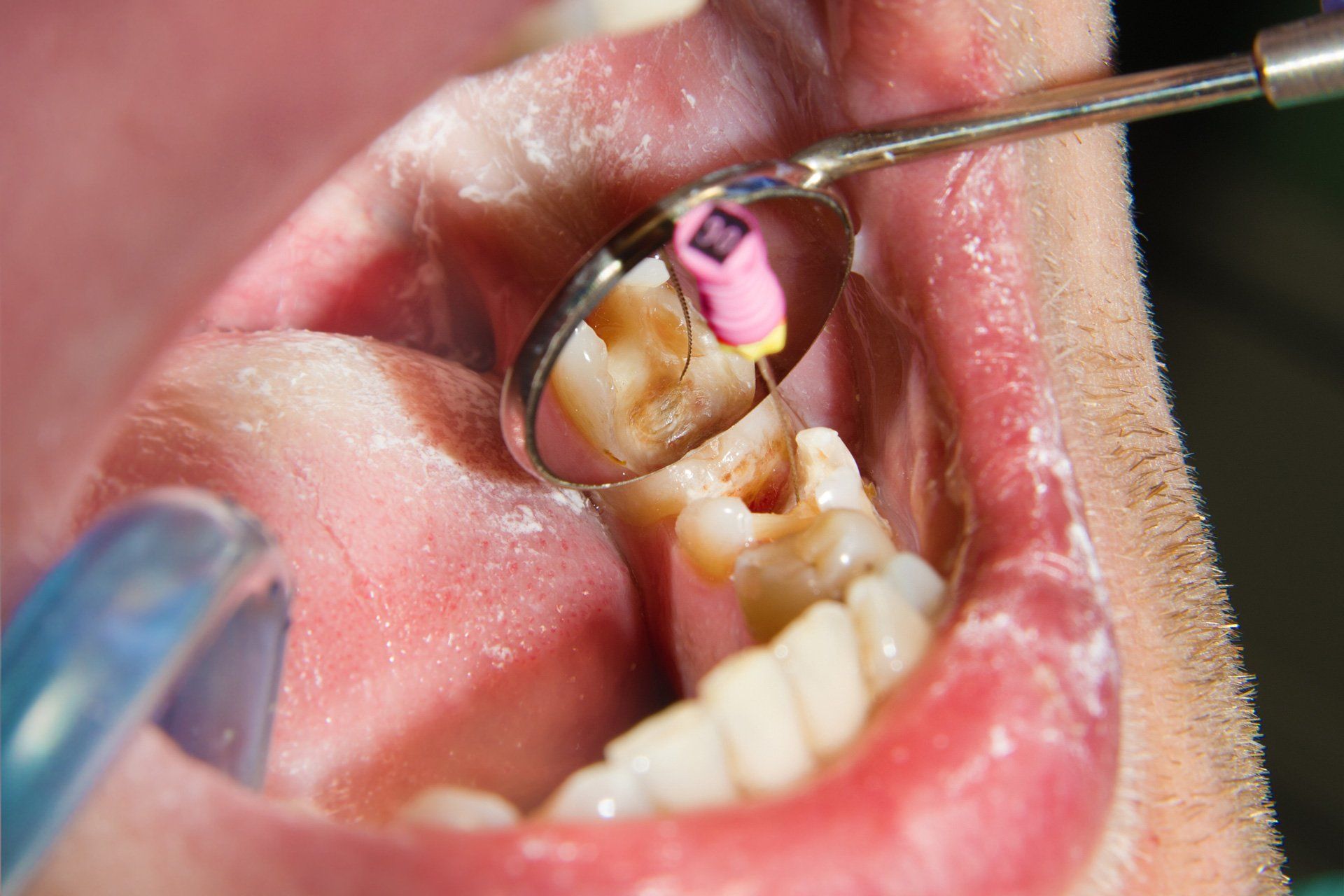 A view of the teeth ready for a root canal – Blacktown, NSW – Smiles for All A view of the teeth ready for a root canal – Blacktown, NSW – Smiles for All