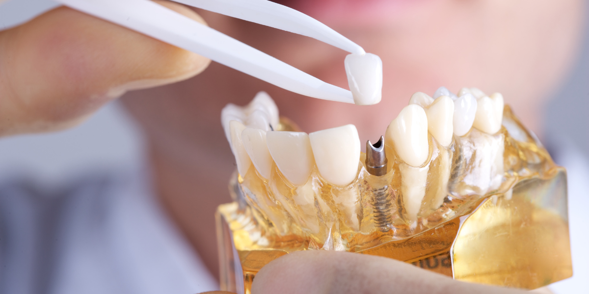 A dentist is holding a model of a person 's teeth with tweezers.
