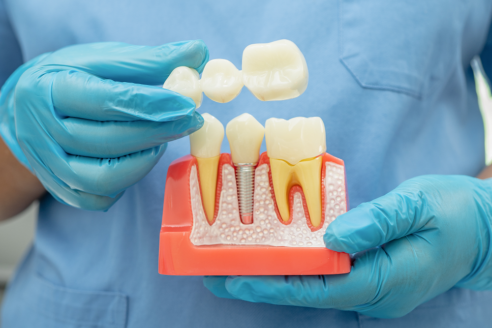 A person is holding a model of a person 's teeth.