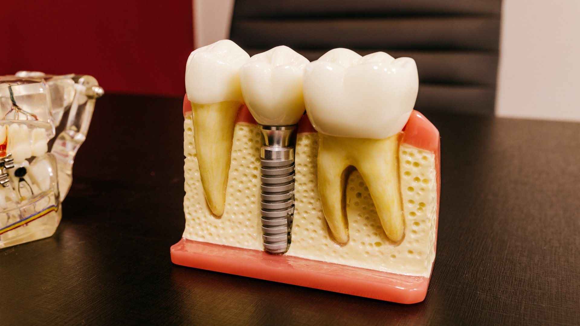 Dental implant model showing a metal implant and two white crowns in pink gum tissue