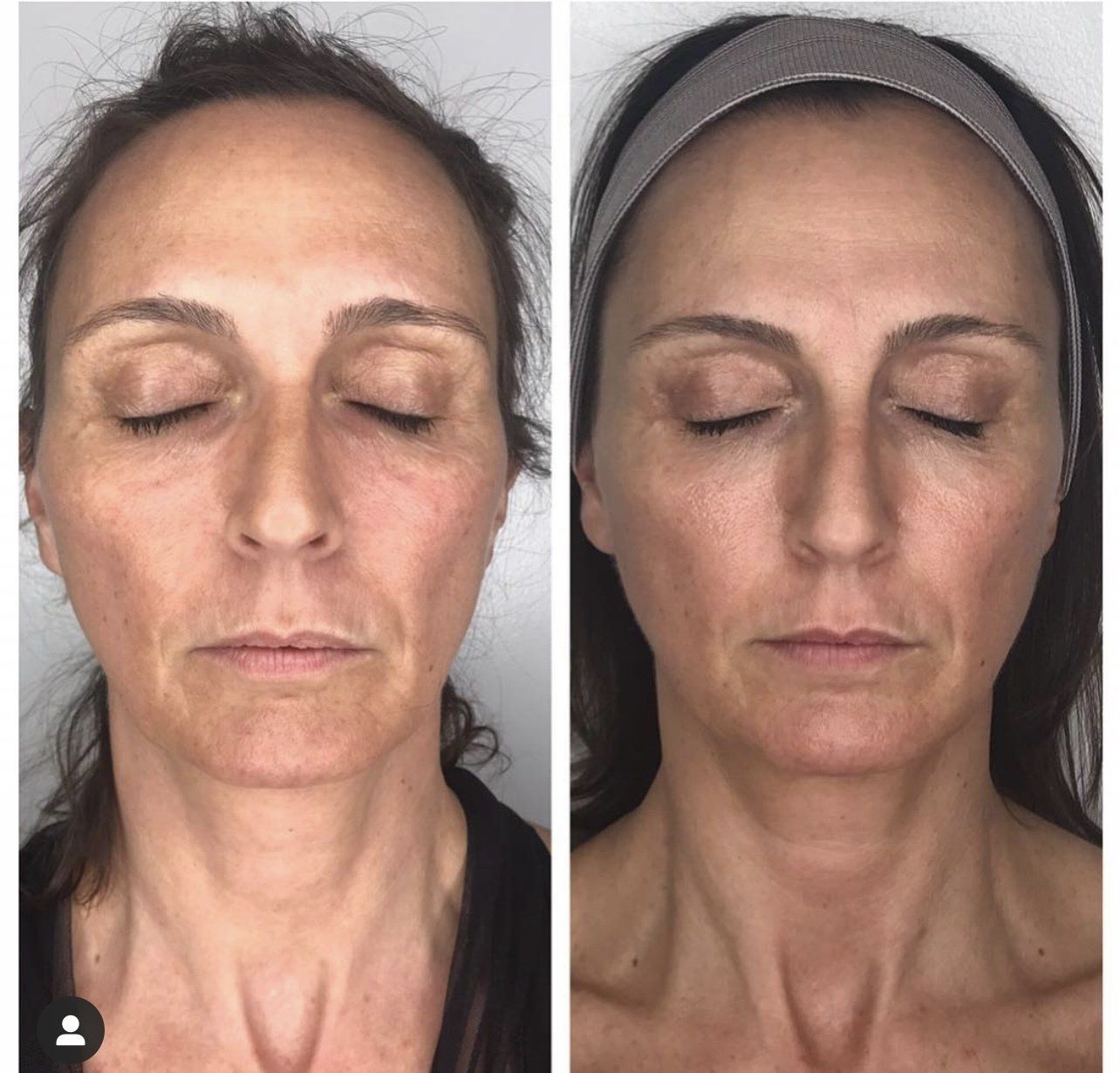Microneedling by Victoria at Iconic Beauty Miami
