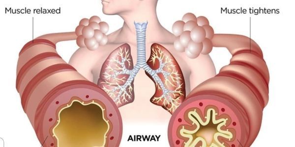 Asthma & Lung Conditions - Mill Park, VIC - Salt & Wellness Haven