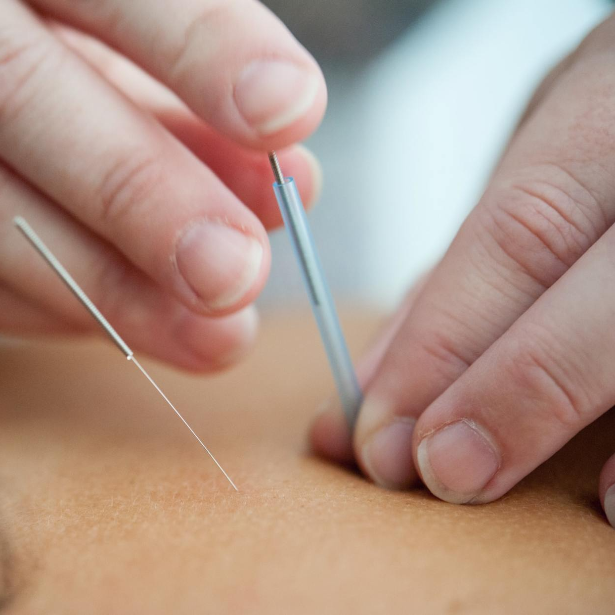 Acupuncture