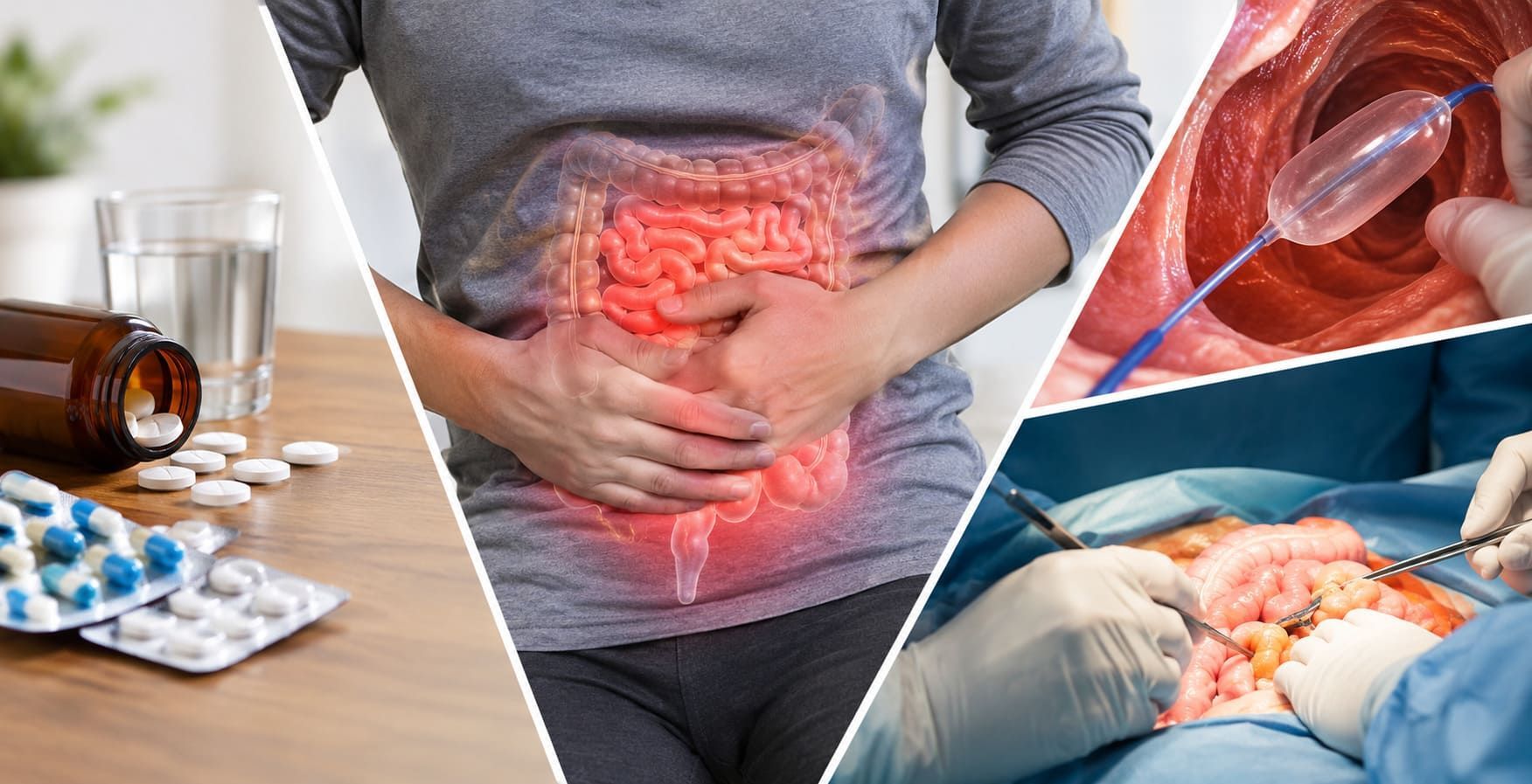 ضيق الأمعاء الدقيقة في كرونز