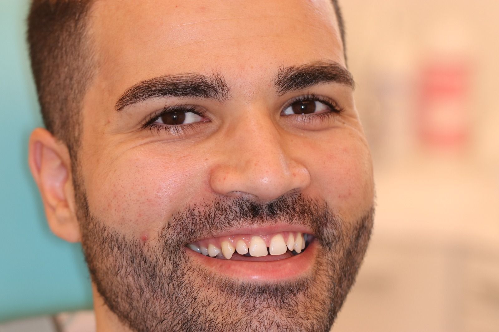 Daniele prima delle faccette