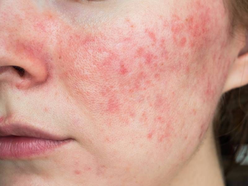 Managing-Rosacea